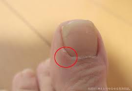 足指の腫れ